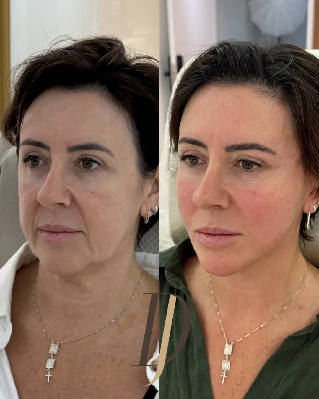 Resultado de harmonização facial: antes e depois 3