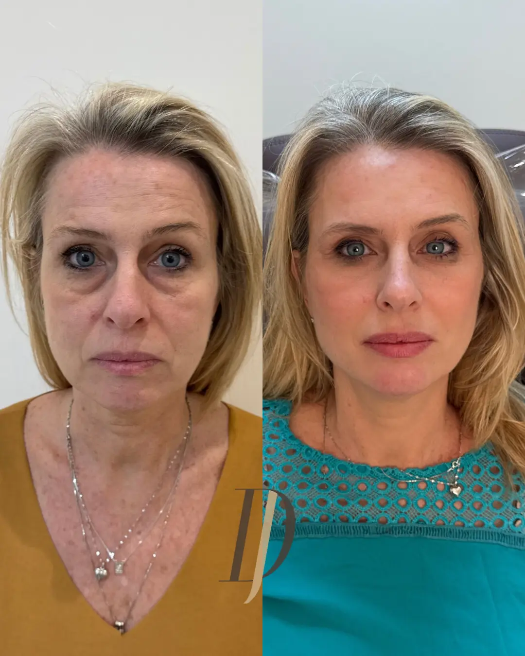 Resultado de harmonização facial: antes e depois 2