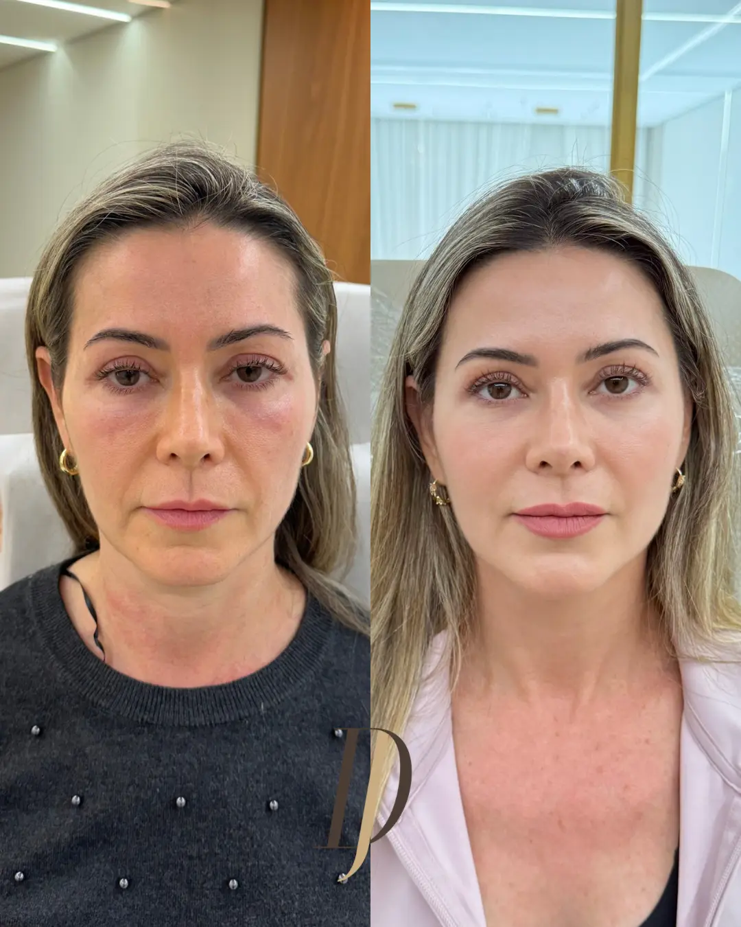Resultado de harmonização facial: antes e depois 1